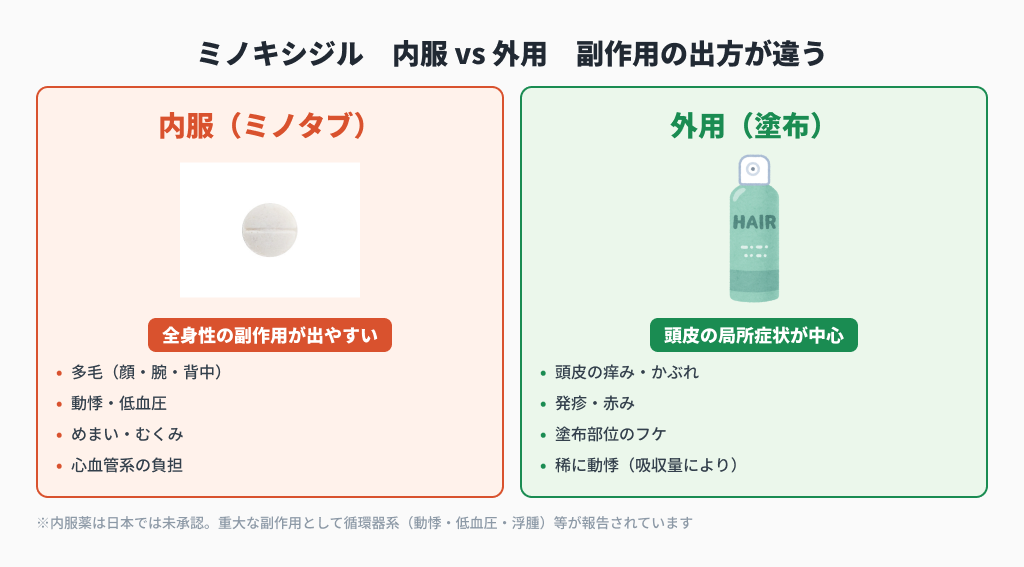 ミノキシジル内服(多毛・動悸・むくみ)と外用(頭皮の痒み・かぶれ)の副作用の出方